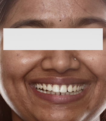 Before: Diastema closure